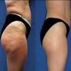 Cellulite Helper أيقونة