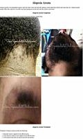 Hair Diseases Affiche