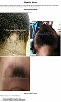 Hair Diseases poster