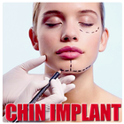 ikon Chin implant
