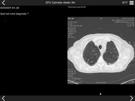 Cours TDM multicoupe du thorax 1 اسکرین شاٹ 3