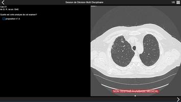 Fibrose pulmonaire 2017 poster