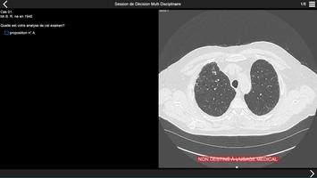 Fibrose pulmonaire 2017 Affiche