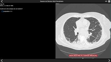 Fibrose pulmonaire 2017 syot layar 1
