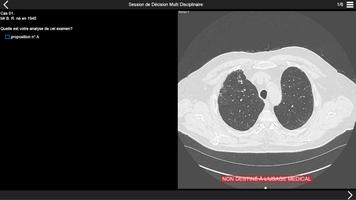 Fibrose pulmonaire 2017 تصوير الشاشة 3