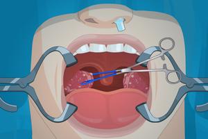 Operate Now: Tonsil Surgery スクリーンショット 3