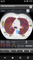 Chest CT Sectional Walker الملصق
