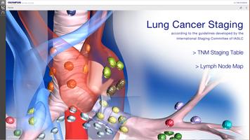 Lung Cancer Staging Table Affiche