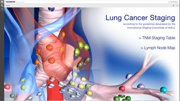 Lung Cancer Staging Table پوسٹر