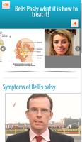 Bells Palsy-poster