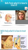 Bells Palsy تصوير الشاشة 1