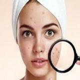 Como curar el acne icône