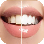 تبييض الاسنان خلطات منزلية