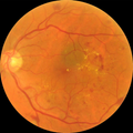 Diabetic retinopathy predictor