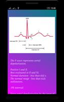 ECG (EKG) Interpretación captura de pantalla 2