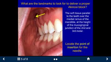 Dental Anesthesia Lite - SecondLook capture d'écran 2