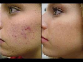 Como eliminar el acné Affiche