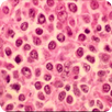 Linfoma folicular APK