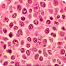 Linfoma folicular APK