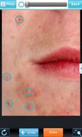 Blemish Remover imagem de tela 2