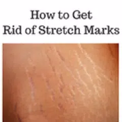 How to get rid of stretch marks