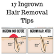 Ingrown hair removal