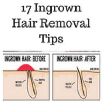 Ingrown hair removal постер