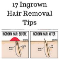 Ingrown hair removal poster
