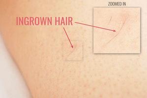 Ingrown hair removal скриншот 1