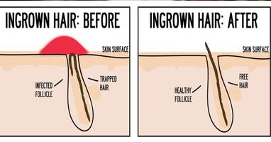 Ingrown hair removal скриншот 2