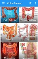 Colon Cancer imagem de tela 1