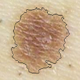 Skin Cancer Image Viewer