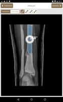 Osteotrauma capture d'écran 3