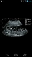 Prenatal Ultrasound Lite capture d'écran 3
