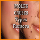 Moles cause and how to remove icono