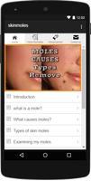 Moles cause and how to remove Poster