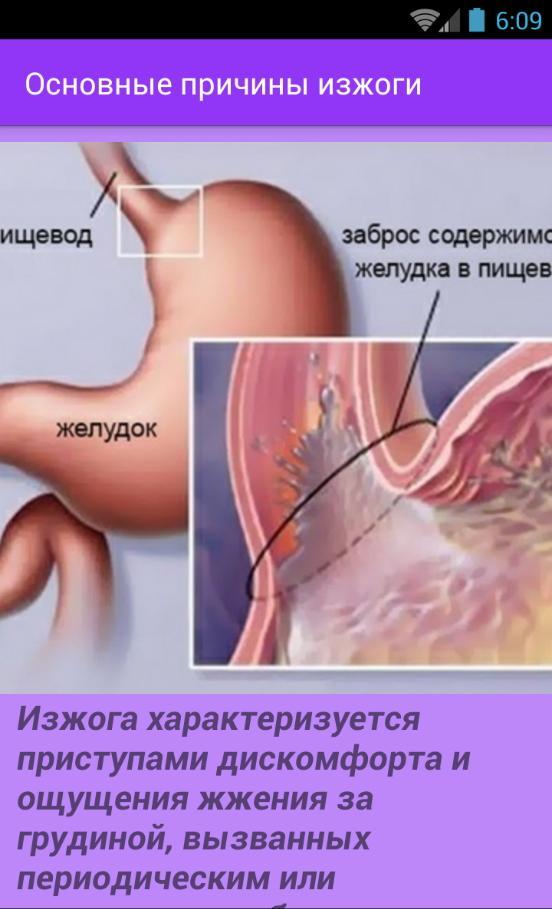 Изжога в пищеводе и желудке