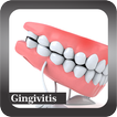 ”Recognize Gingivitis Disease