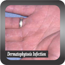 Recognize Dermatophytosis Infection APK