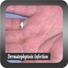 Recognize Dermatophytosis Infection icône