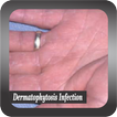 Recognize Dermatophytosis Infection