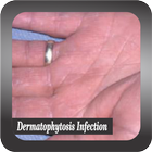 Recognize Dermatophytosis Infection 图标