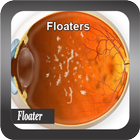 Recognize Floater Disease icône