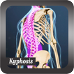 Recognize Kyphosis Disease