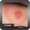 Recognize Lyme Disease
