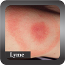 Recognize Lyme Disease APK