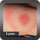 Recognize Lyme Disease-APK