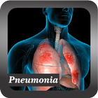 Recognize Pneumonia Disease Zeichen