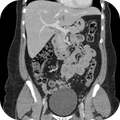 CT Abdomen Pelvis