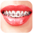 ”Braces: Real Teeth Braces Pict